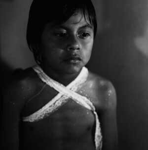 A young boy with white bandages around his neck.