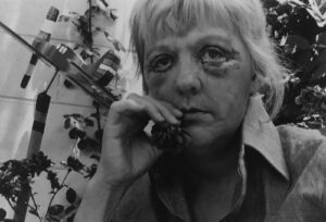 A woman with black eye and red nose talking on the phone.